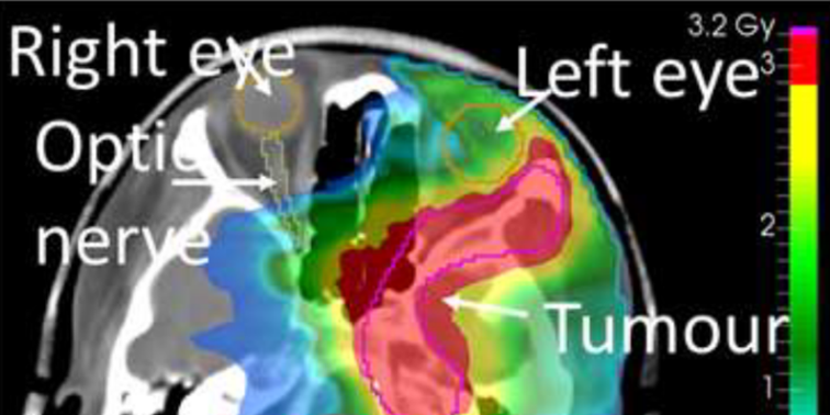 MRT-Aufnahme eines Kopfes, bei dem ein vorhandener Tumor in Falschfarben eingefärbt wurde.